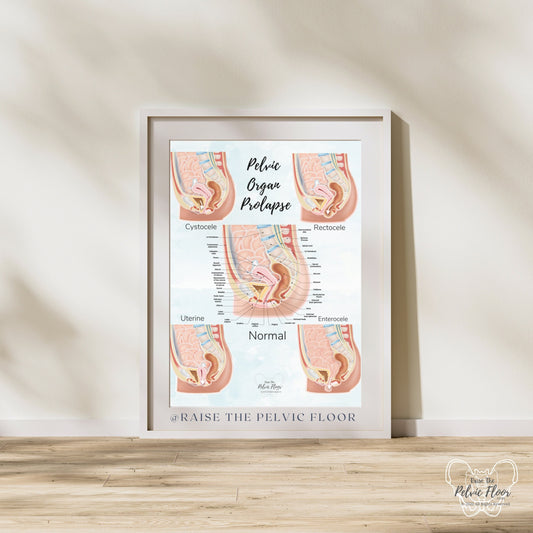 Prolapse Bladder, Rectum, Uterus, Intestine Art Print | Cystocele, Rectocele, Uterine Prolapse and Enterocele | Pelvic Floor