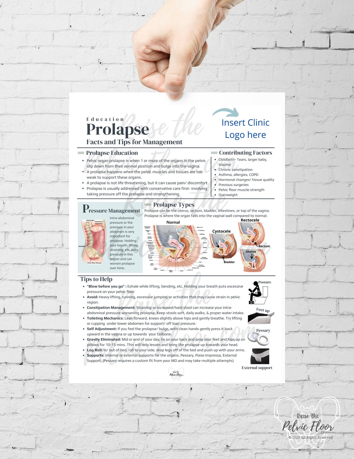 DIGITAL DOWNLOAD* Prolapse Patient Education Handout | Rectocele, Cystocele, Uterine Bulge 8.5 x11" Handout Info | Pelvic Floor Health